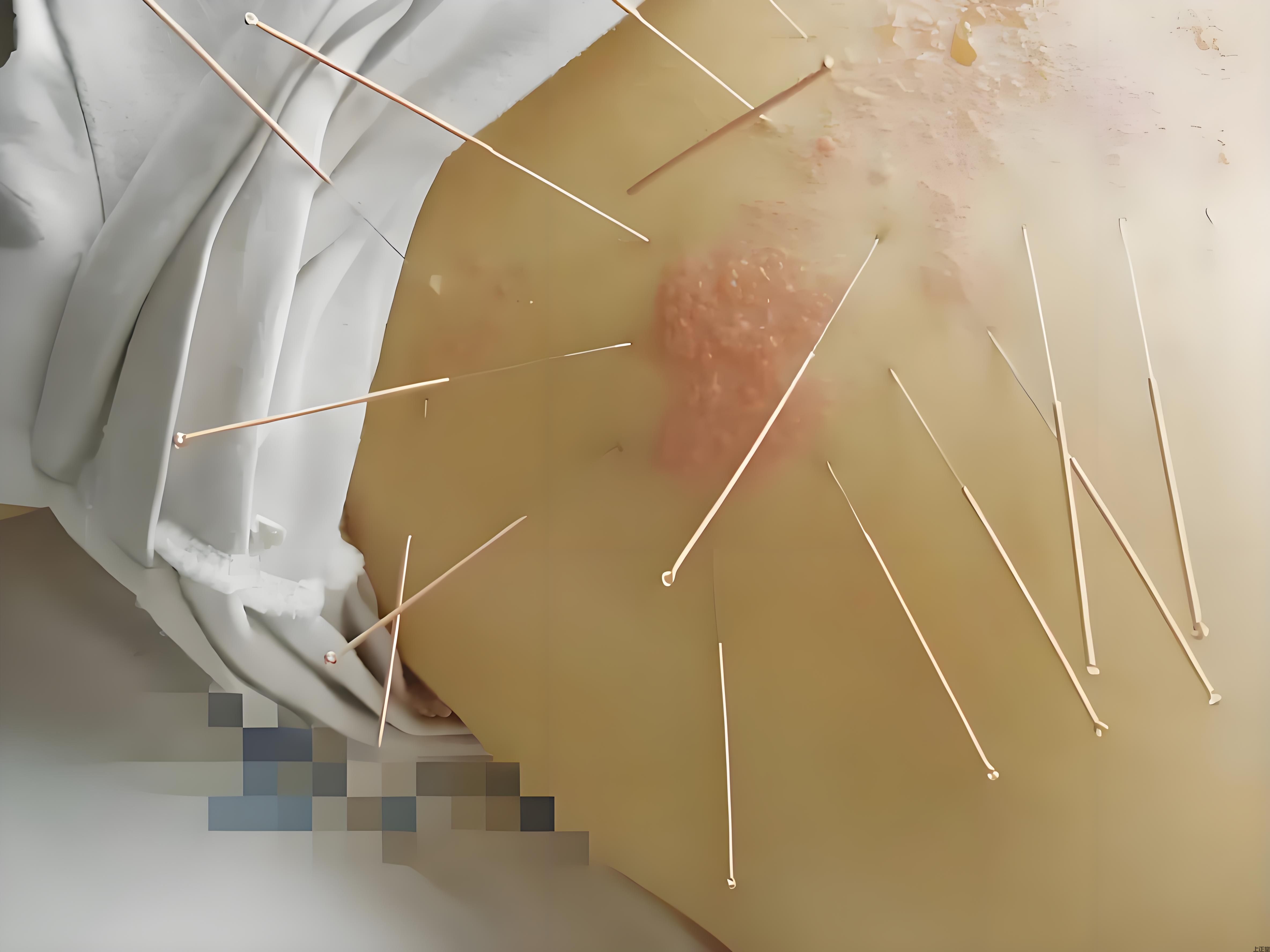 哈尔滨上正堂：雷竞技最新下载地址治疗带状疱疹，传统医学绽放新光彩