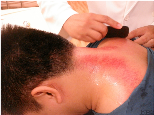 刮痧排湿有效果吗